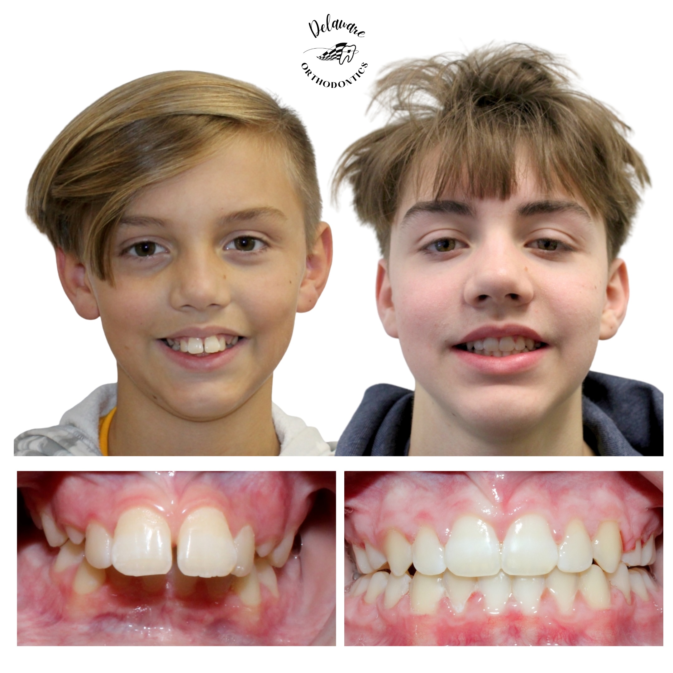 Before and after orthodontic treatment results 1