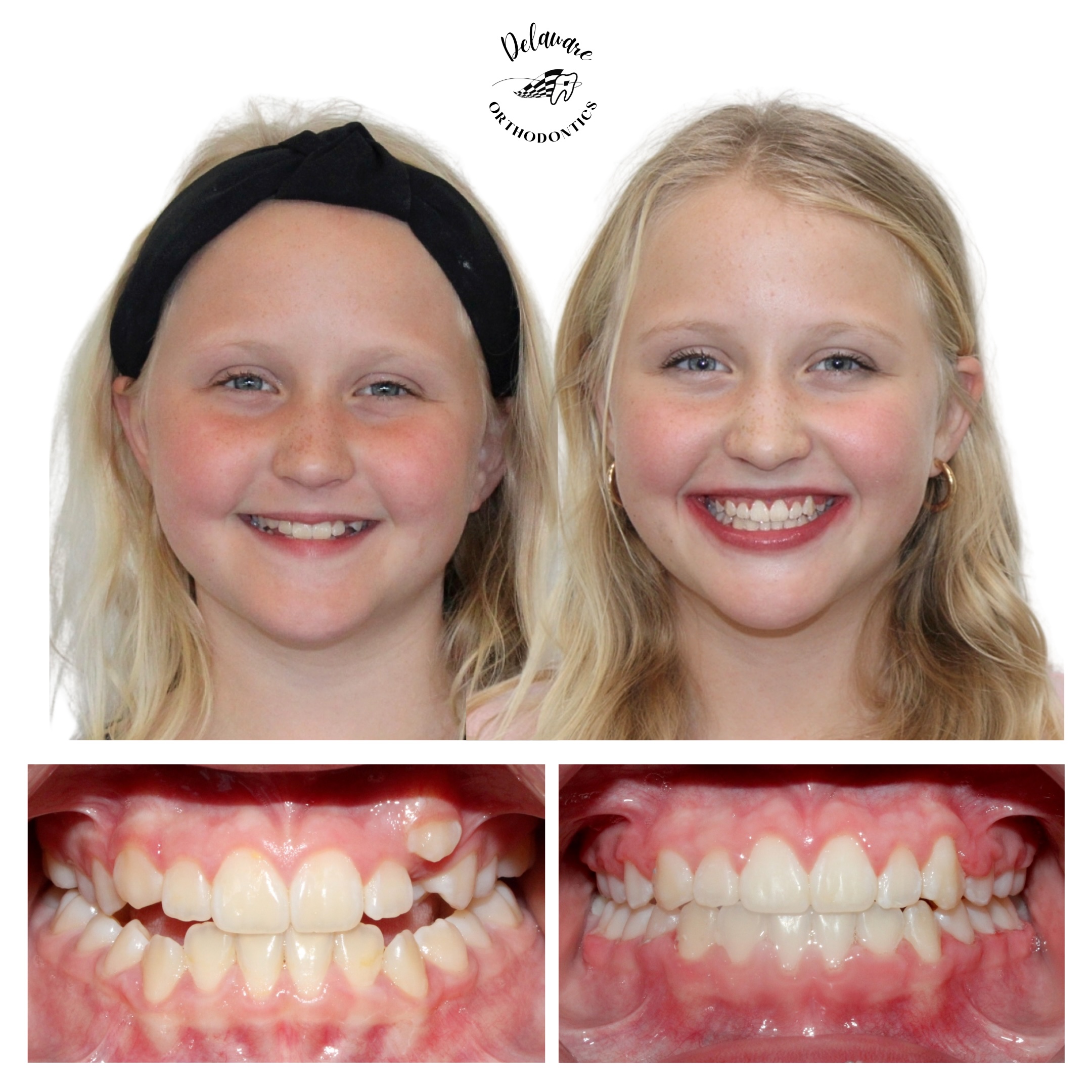 Before and after orthodontic treatment results 2