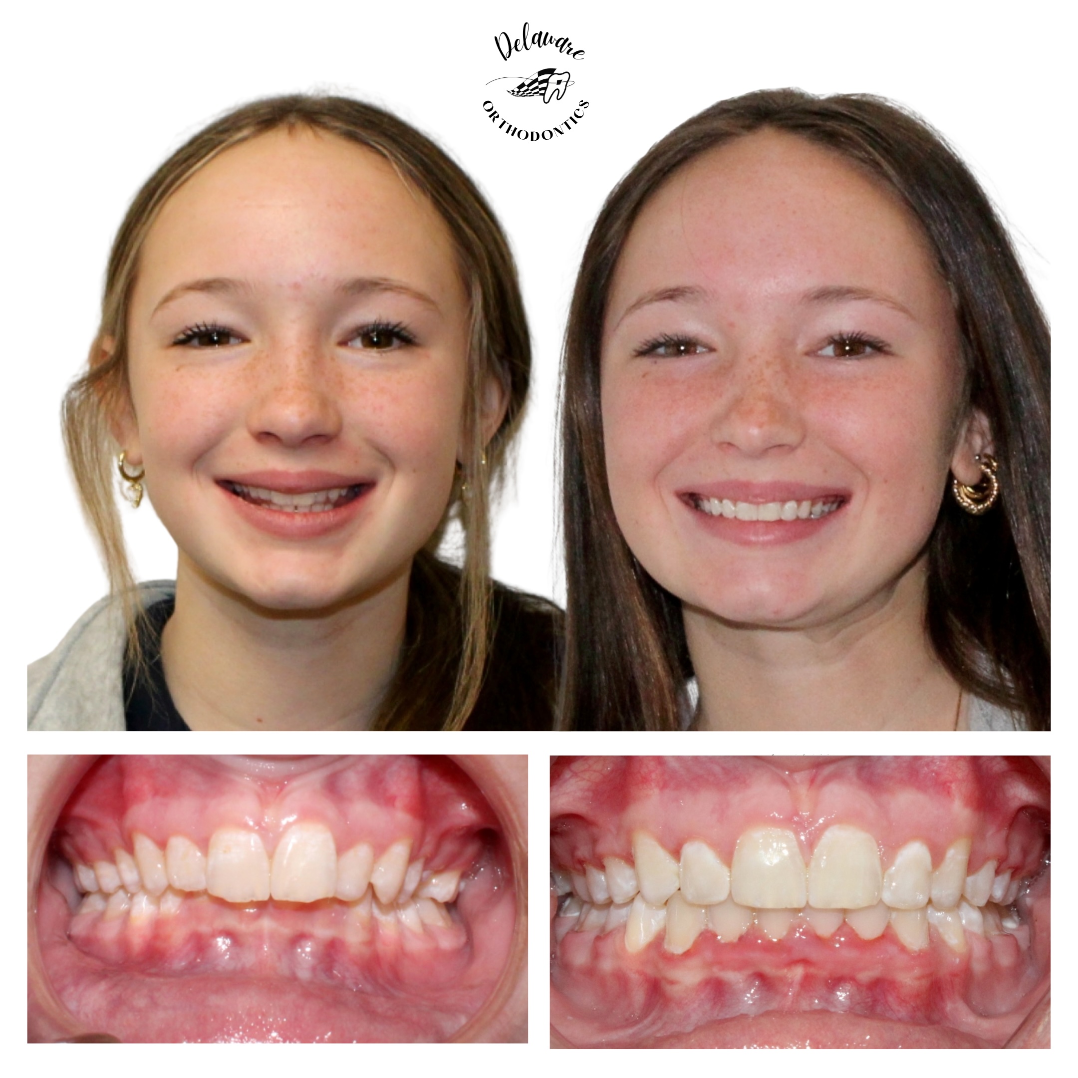 Before and after orthodontic treatment results 3